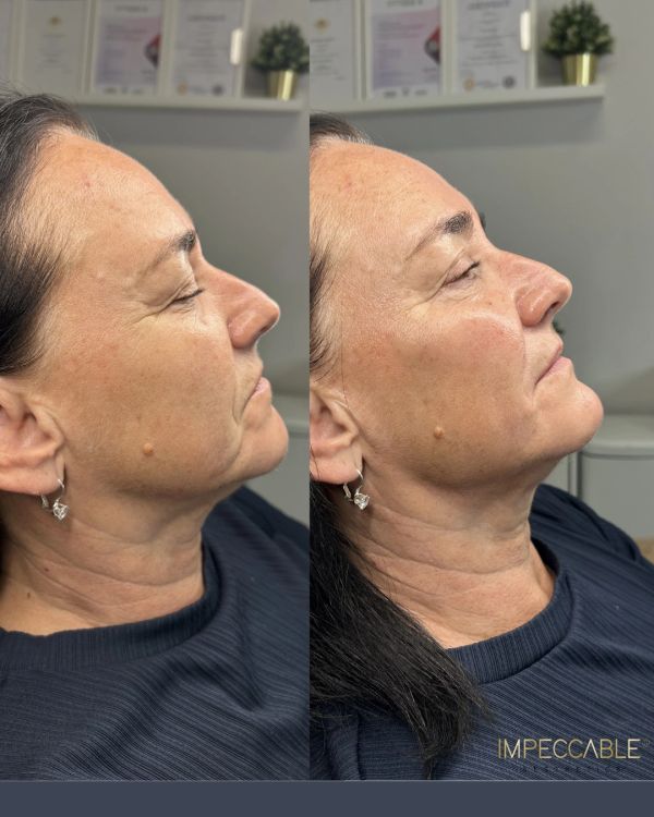 Side-by-side comparison of a woman's face showing skin improvement.