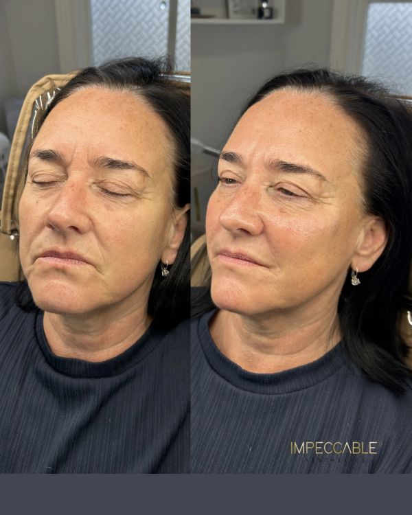 Before and after facial treatment on a woman's face.