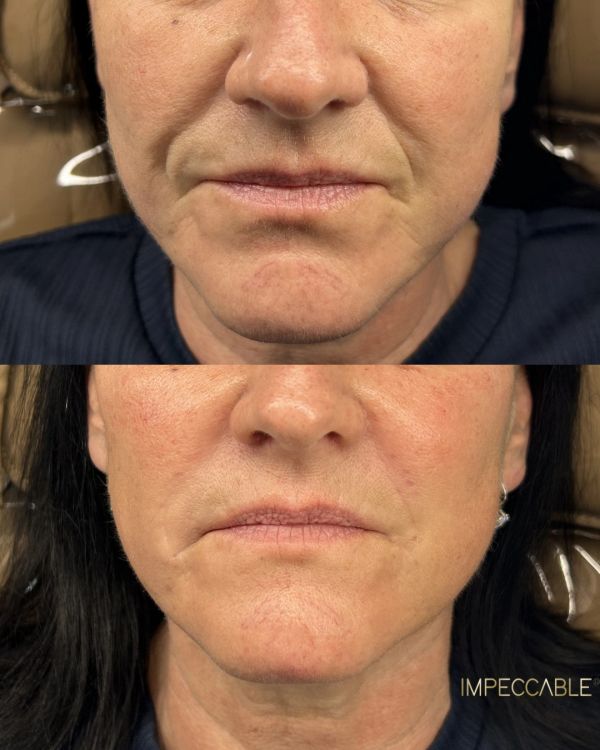 Before and after skin treatment on the lower face area.