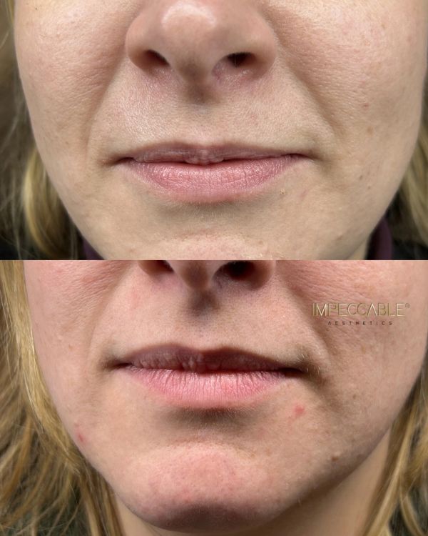 Close-up of lips and lower face before and after treatment.