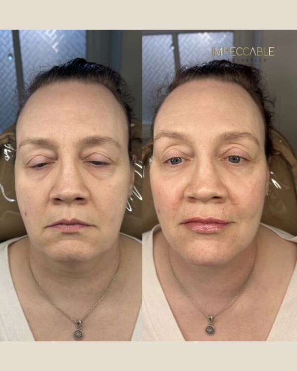 Before and after cosmetic facial treatment on a woman.