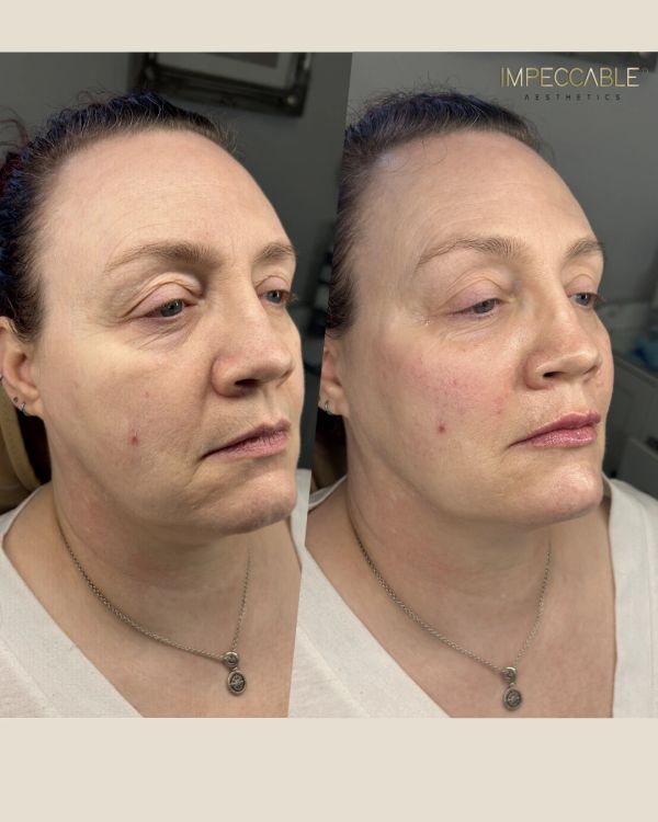 Side-by-side facial comparison before and after aesthetic treatment.