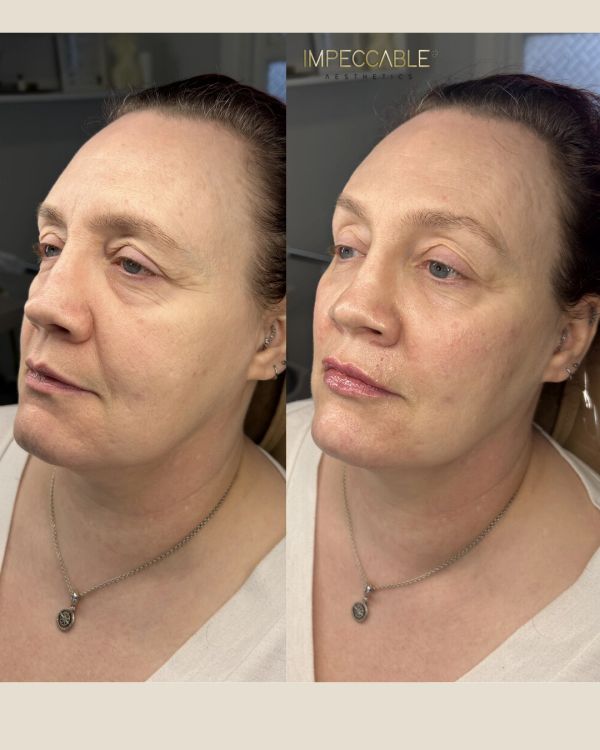 Before and after facial aesthetic treatment showing smoother lips and improved skin texture.