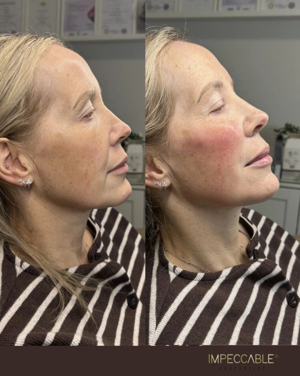 Side-by-side before and after facial aesthetic treatment photos.