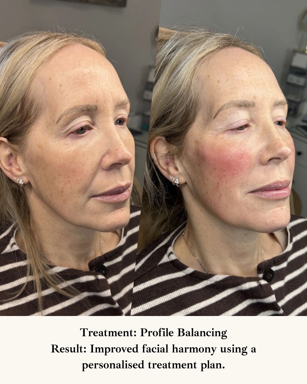 Before and after profile balancing treatment showing enhanced facial symmetry.