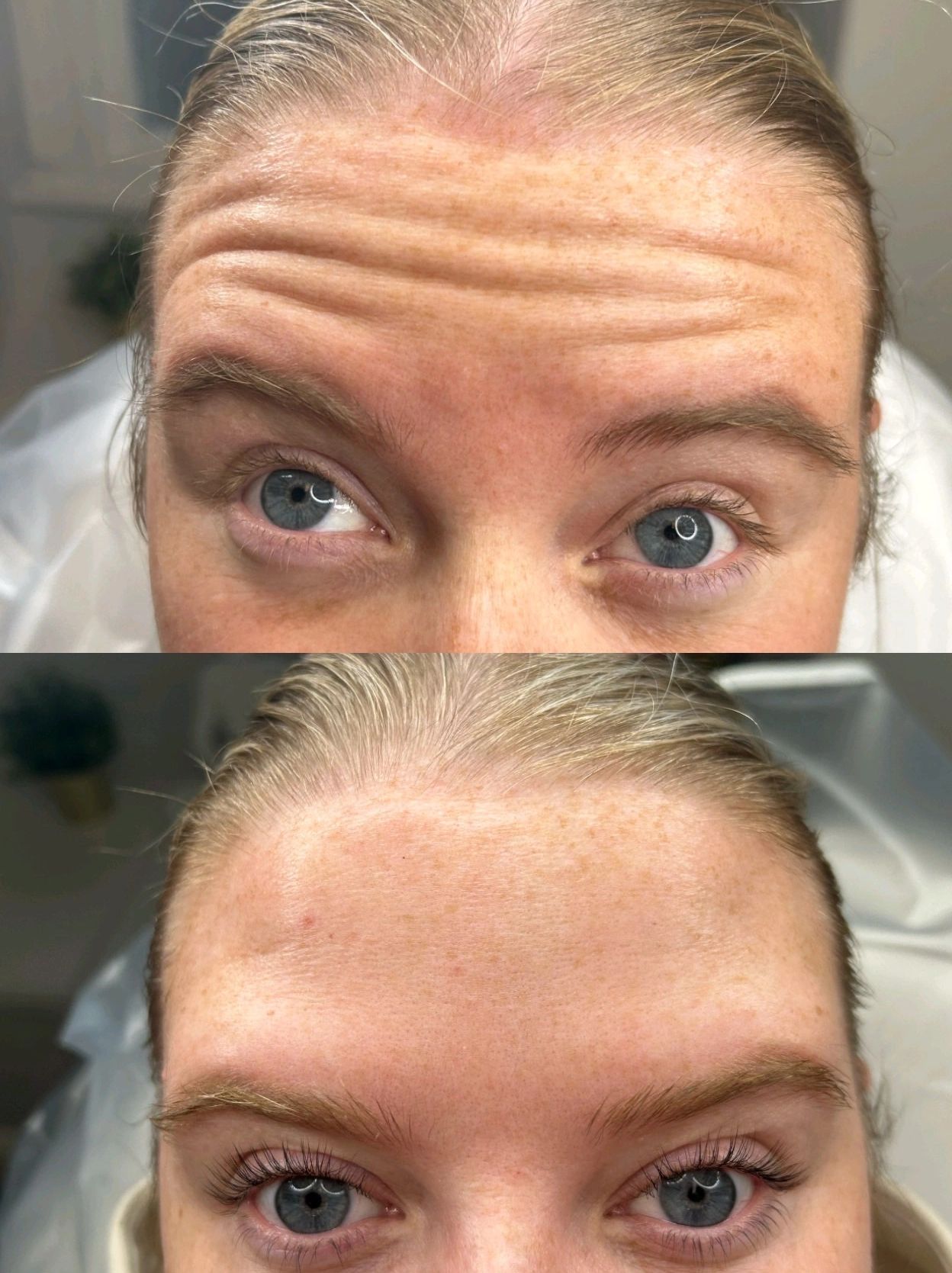 Comparison of a woman's forehead and eyes showing reduced wrinkles and enhanced eyelashes.