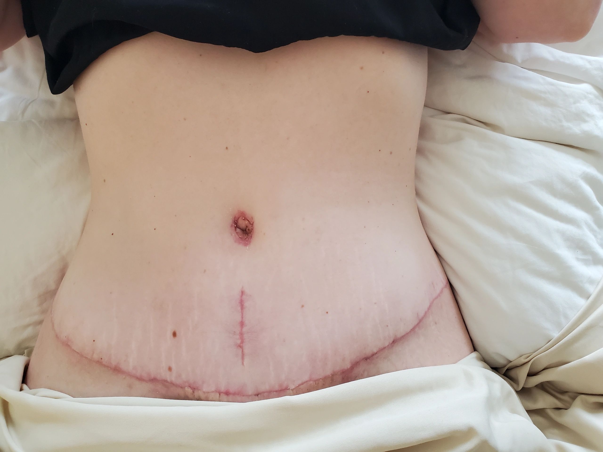 Post-Op Tummy Tuck progress. Massive swelling occurred between Post-Op day  1 vs. day 7 as well as drainage : r/PlasticSurgery