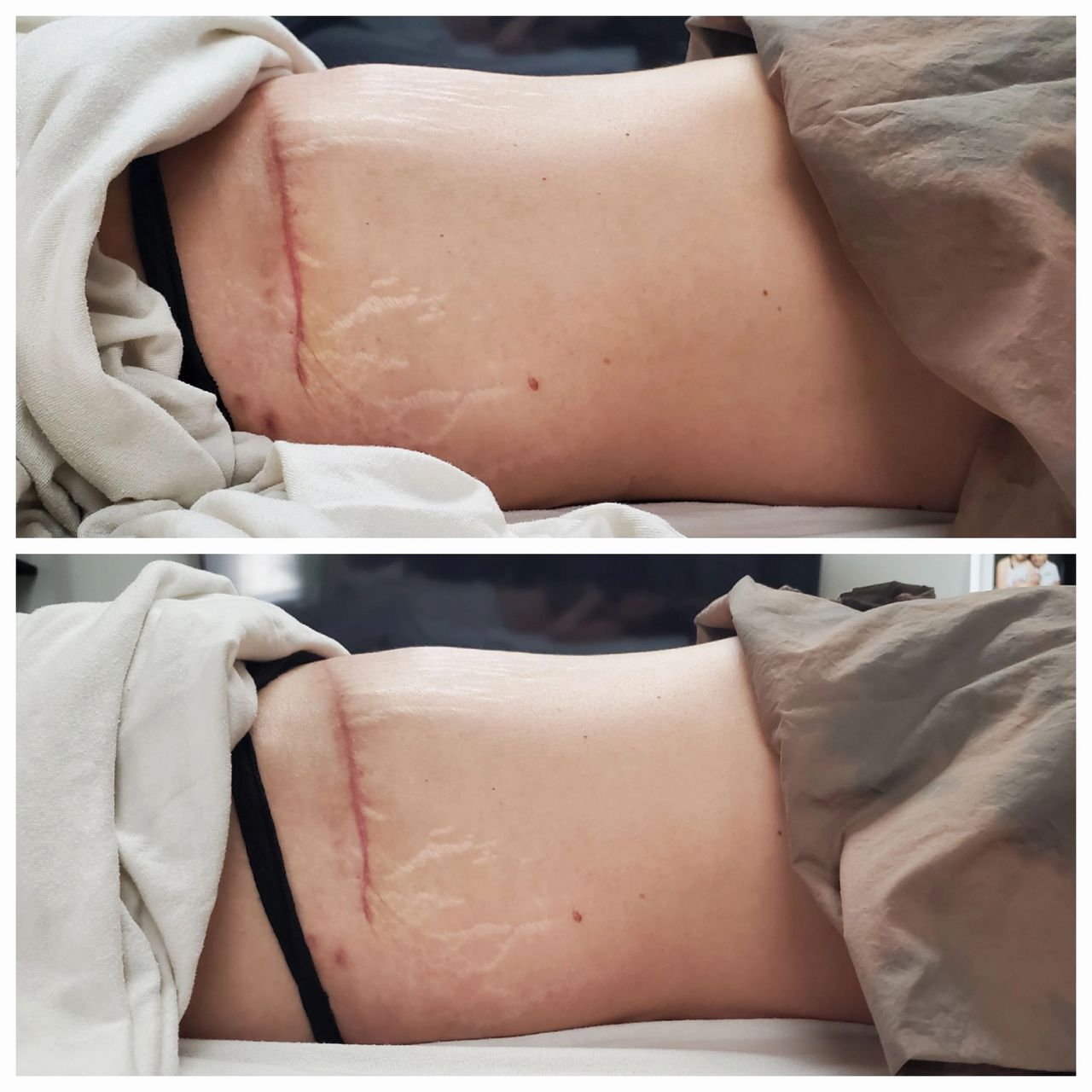 Before/After Post Op Massage — Louisville Lymphatic Center