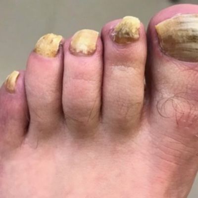 FUNGAL NAIL INFECTION