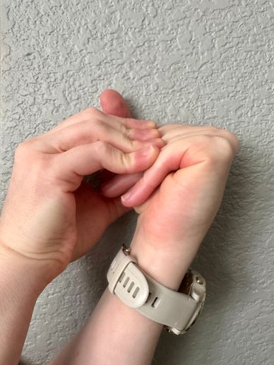 Sara's hand demonstrating excess flexion and compressibility 