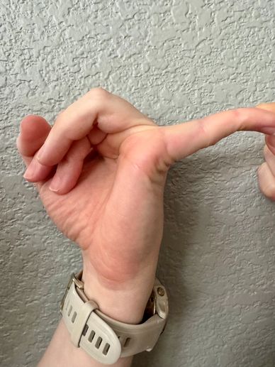 Sara's hand demonstrating excess extension