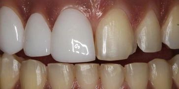 Smile infinity veneers facettes abidjan 