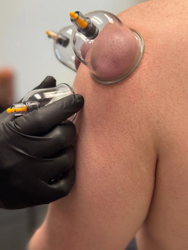 Cupping therapy