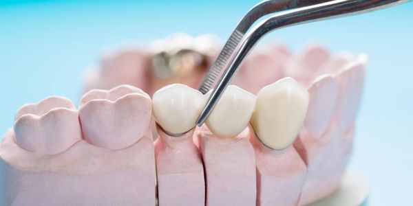 Dental bridge