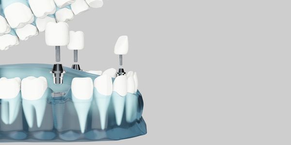 Dental implant