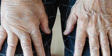 A hand with lymphoedema comparing with the other side