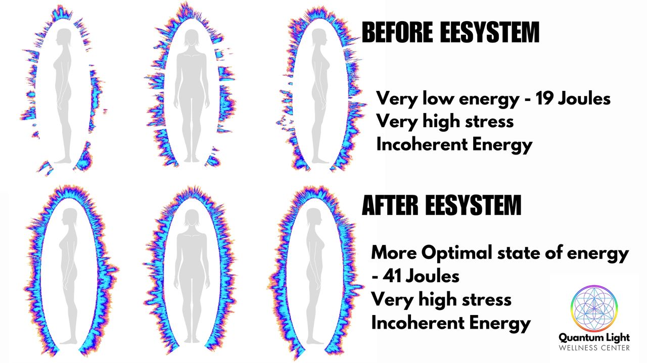 Before her EESystem session, she was highley stressed, and it showed in her energy field. We measure energy in Joules, and they were very low (19 joules). Optimal is between 40 & 60. In her Before Scan, you can see breaks in her energy field. She had a stroke, and her body was still in a high state of stress. After 2 hours in the EESystem, her energy went from 19 to 41 joules! All of the breaks in her energy have been filled in. Although there is room for her energy to become more coherent and balanced, this is a remarkable improvement after a single 2 hour session! After 5 months of 2 hour sessions each week, she went from being on multiple medications to a low dosage of just one! She is optimistic about being able to be completely medication free! Before her EESystem session, she was highley stressed, and it showed in her energy field. We measure energy in Joules, and they were very low (19 joules). Optimal is between 40 & 60. In her Before Scan, you can see breaks in her energy field. She had a stroke, and her body was still in a high state of stress. After 2 hours in the EESystem, her energy went from 19 to 41 joules! All of the breaks in her energy have been filled in. Although there is room for her energy to become more coherent and balanced, this is a remarkable improvement after a single 2 hour session! After 5 months of 2 hour sessions each week, she went from being on multiple medications to a low dosage of just one! She is optimistic about being able to be completely medication free!