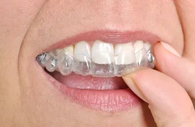 Invisalign Treatment