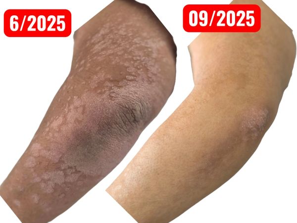 Comparison of skin improvement between June and September 2025.