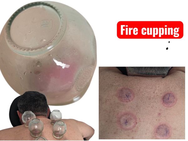 Fire cupping is an ancient therapy  - suction cup lift skin with a flame vacuum, boosting healing, 