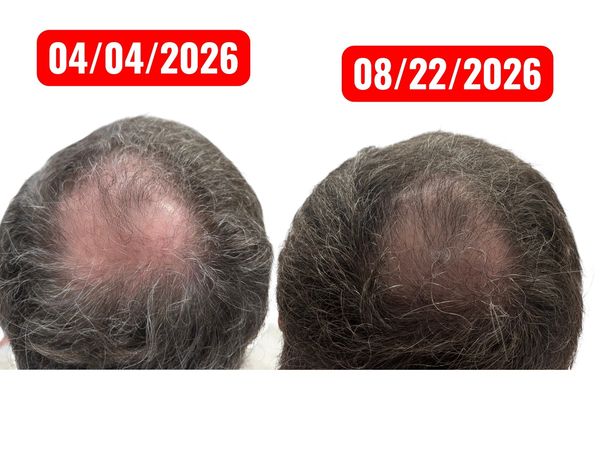 Androgenic Alopecia. hair loss , patient pictures before treatment and 4 month latter 
