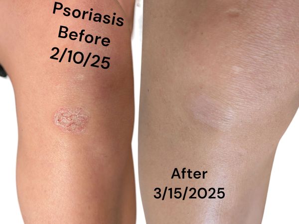 Close-up of dry, cracked skin patch and healed skin area on arm.