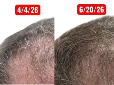 Hair growth progress over two months.