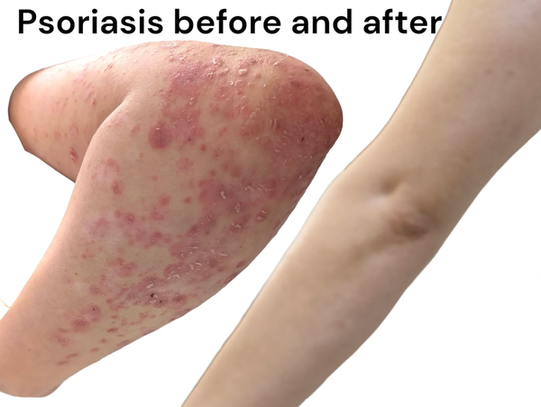 Psoriasis treatment with Autohemotherapy and PRF patient pictures before and after treatment