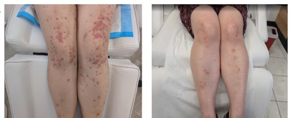 Before and after treatment images showing significant improvement in leg skin condition.