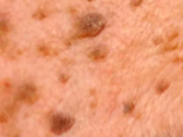 Close-up of skin with  Seborrheic Keratosis - A common,  skin growth that looks "stuck on" the skin