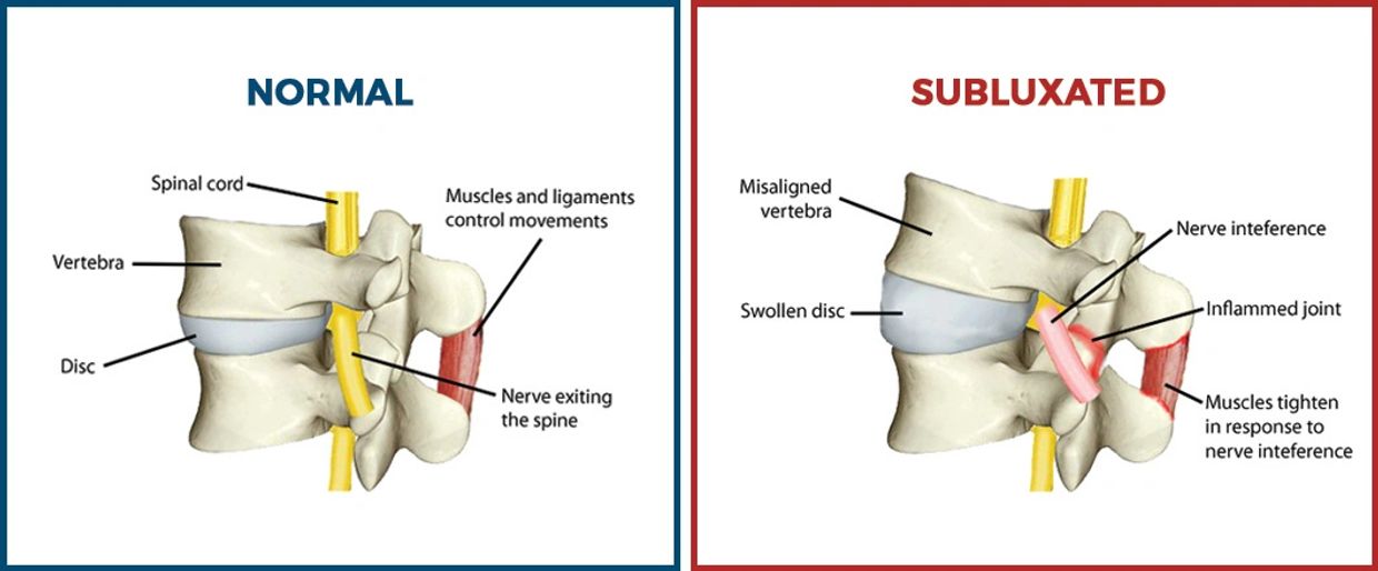 Lumbar Subluxation