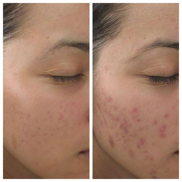 Acne treatment results: before and after