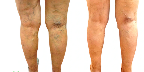 varicose vein treatment nyc