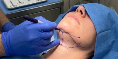 Surgeon marking patient's chin for a procedure.