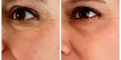 Skin boosters-Regenovue and Profhilo.
