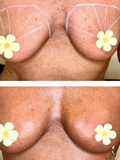 breast filler natural breast enlargement