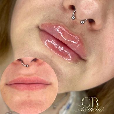 lip filler subtle natural lift