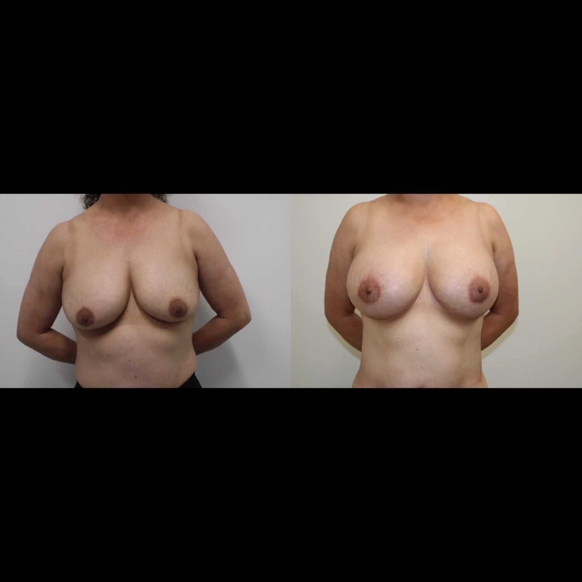 Before image natural breast and position After image: enhanced breast shape and elevated position