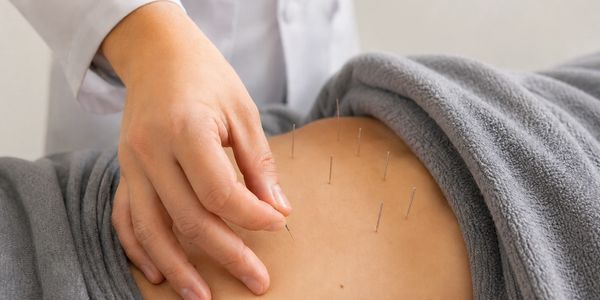 Acupuncture needles inserted in a person's back during treatment.