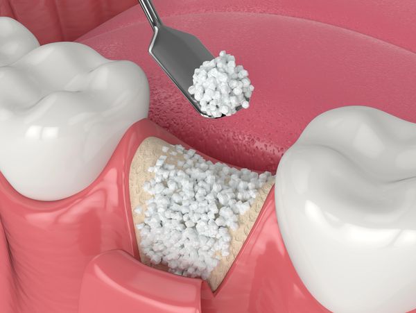 Dental bone Graft.