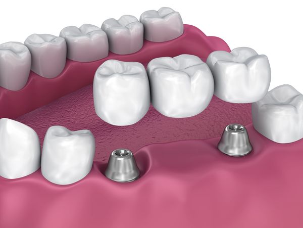 Dental Bridge.