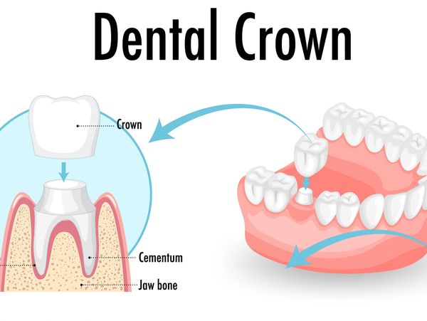 How a dental crown is installed.