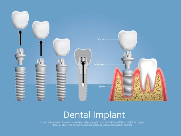 Dental Implants.