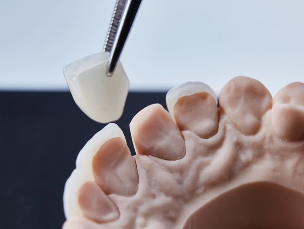 Dental Veneers on a dental study model.