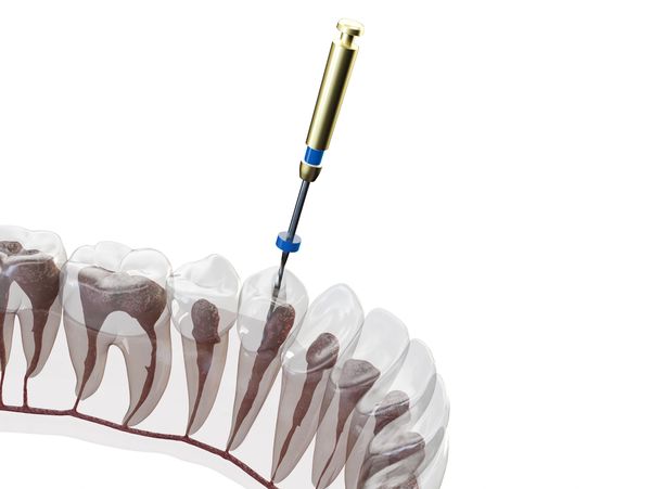 Root Canal file.