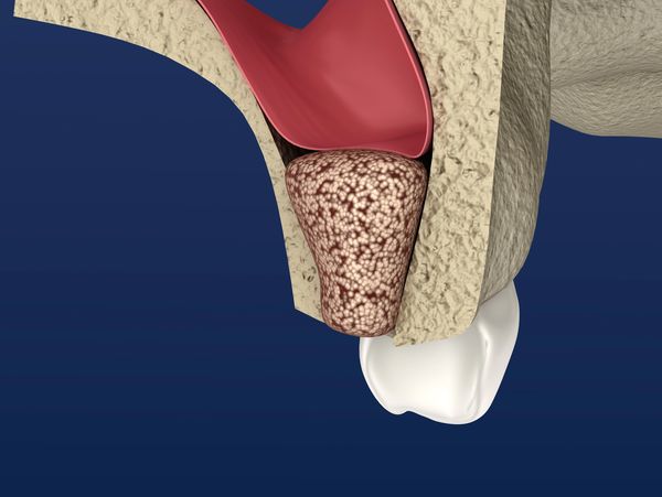 Dental Sinus Lift.