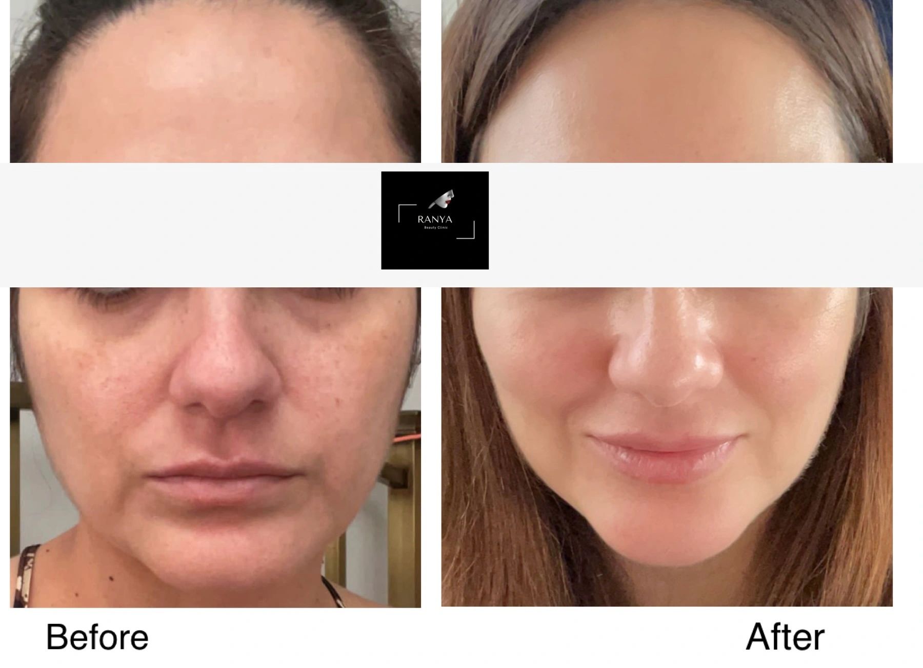 Skin Rejuvenation helps unify skin tone, clear blemishes, gives radiance & hydration 
