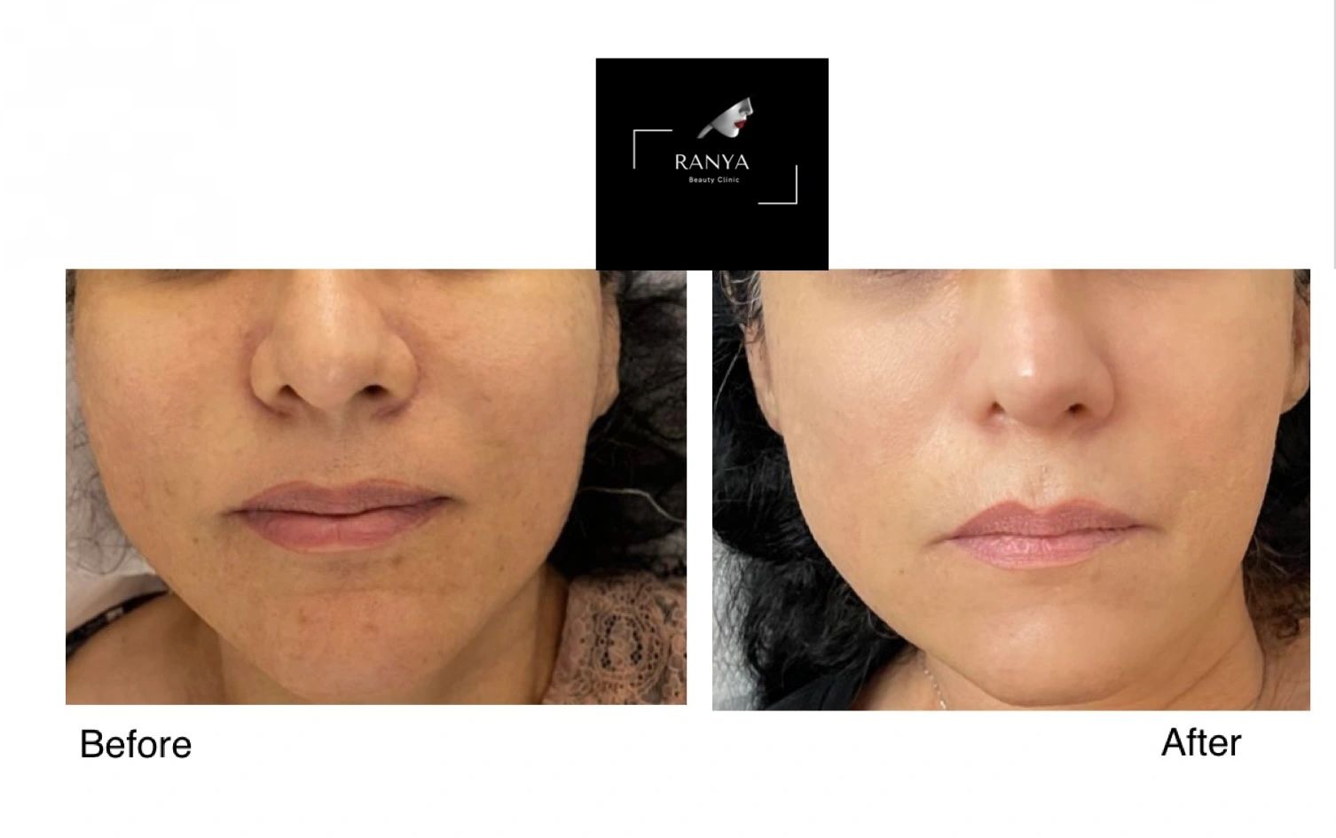Mesotherapy before after, dull skin, glowing skin clinic willesden queens park kilburn hampstead   