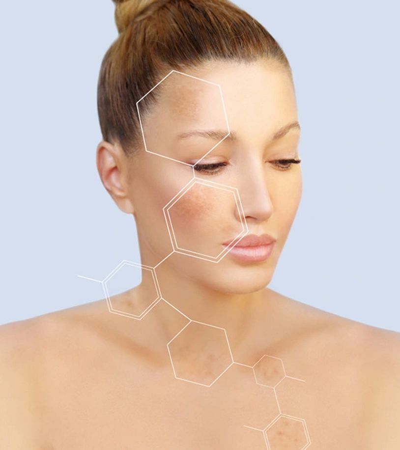 hyperpigmentation treatment near me, willesden kilburn hampstead queens park cricklewood nw6 