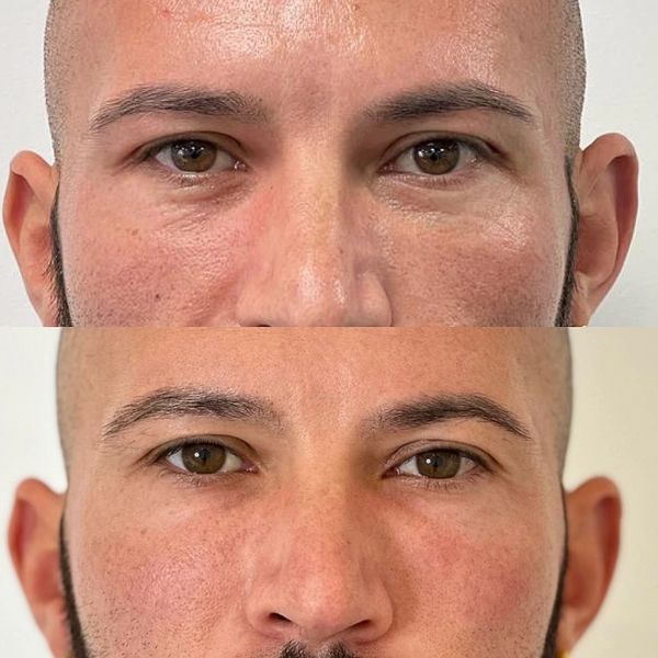 Before and after pictures of a man after a anti-wrinkle treatment